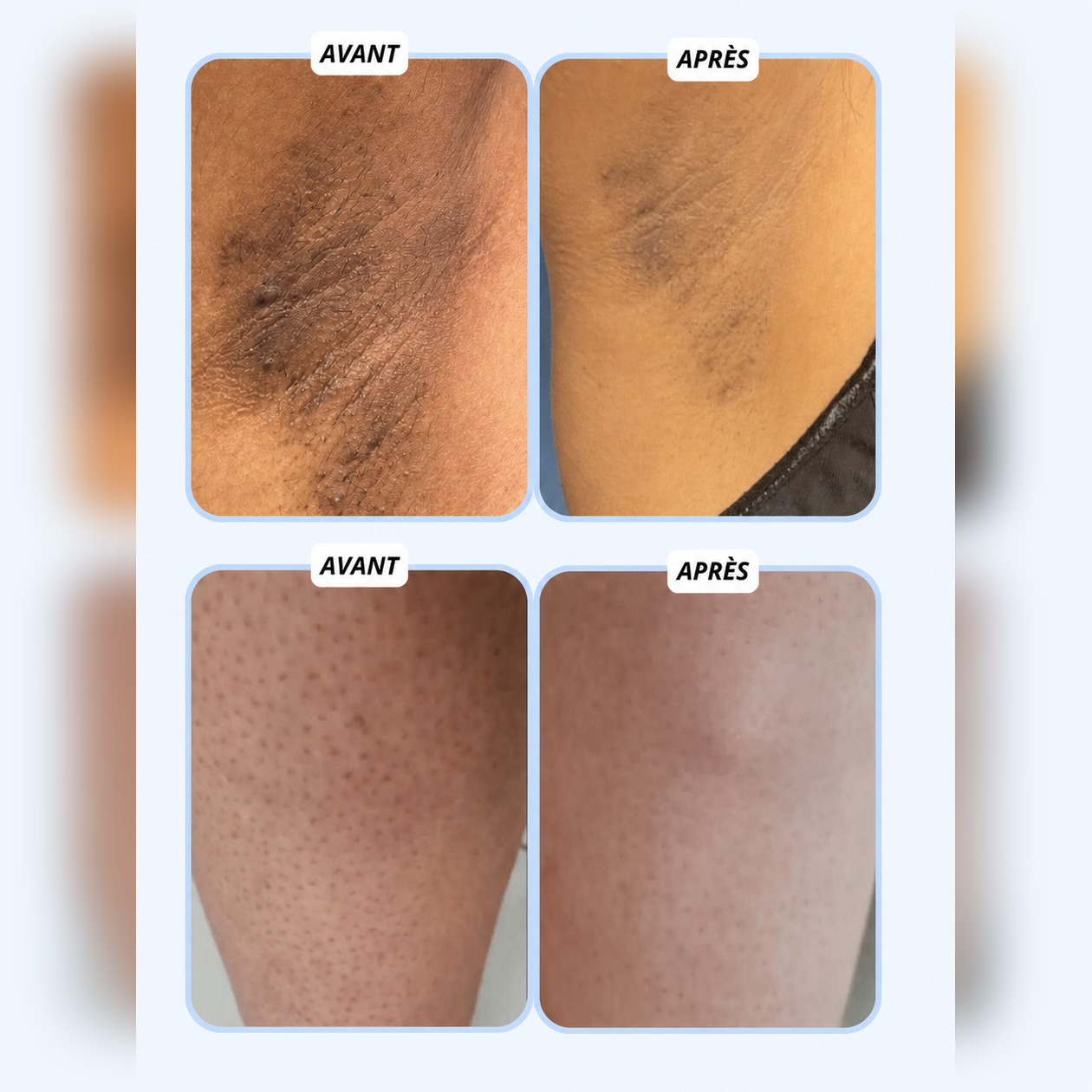 Serviette de Douche Exfoliante Antibactérienne Solmarea